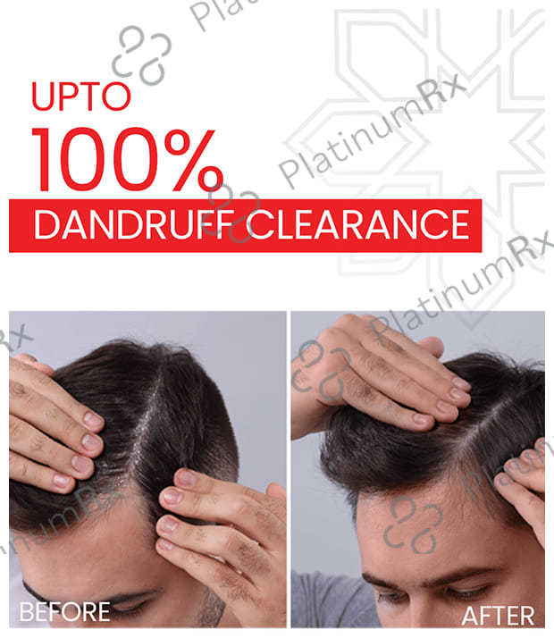 Lupizol ZS Anti dandruff Shampoo 100ml