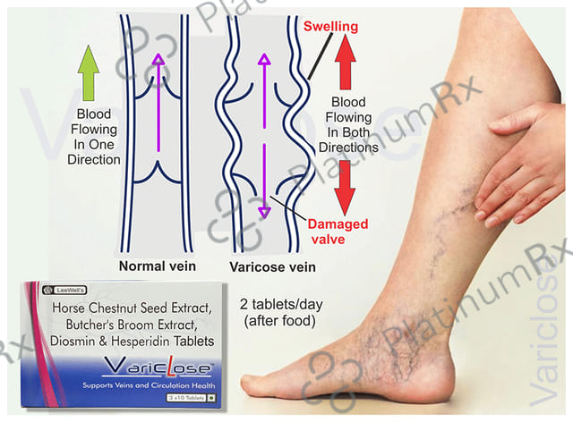 Variclose Poor Blood Flow, Micro Circulation Aid for Varicose Veins & Piles - Aescin, Diosmin & Hesperidin Tablet