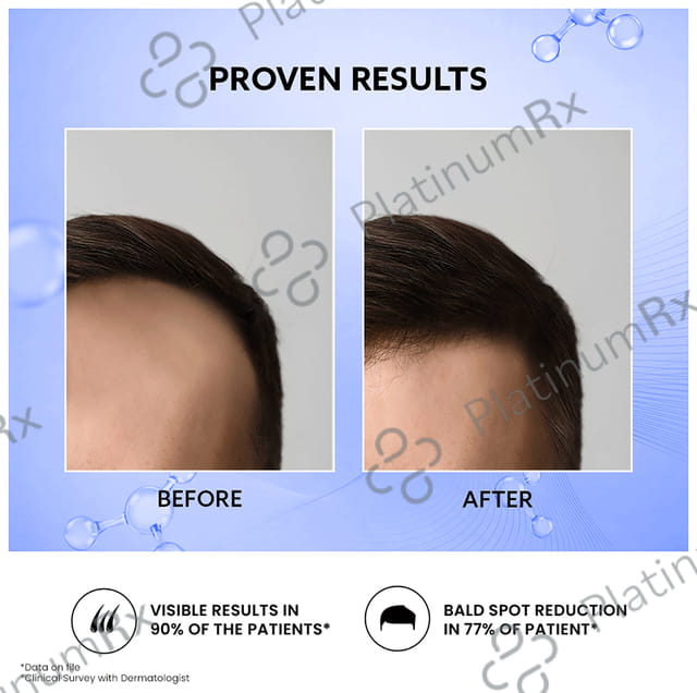 Mintop Forte 10% Hair Restore Formula Lotion 60ml