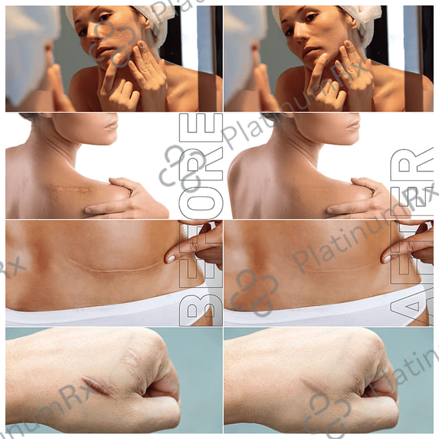 Epifect 100mg Injection